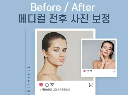 자연스러운 고퀄리티 인물보정, 병원 메디컬 전후사진