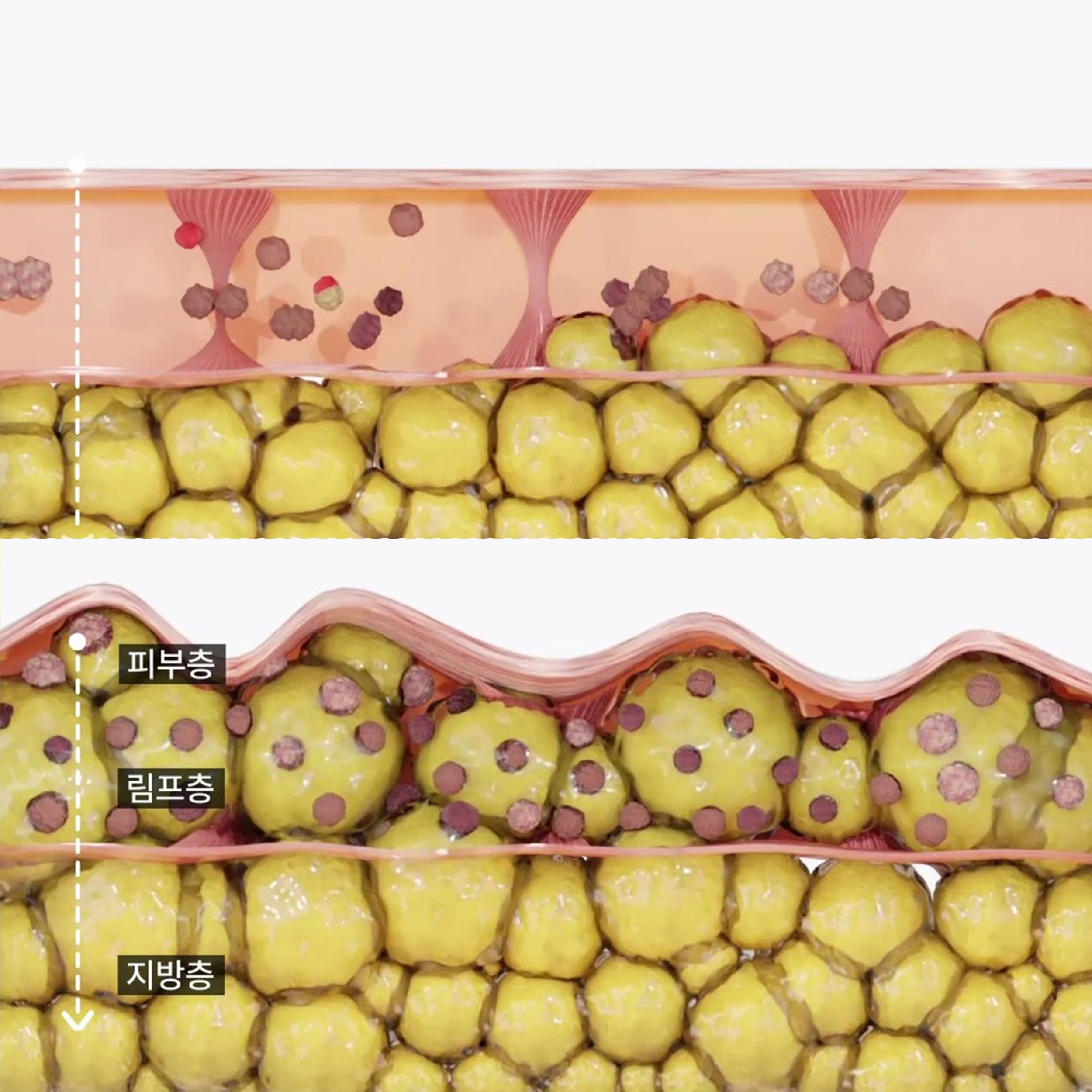 포트폴리오-[GIF모션 영상] 지방이 림프층에 넘어와 림프층을 막는 GIF 영상