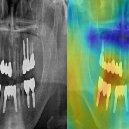 포트폴리오-환자 치아 이미지분석을 통한 임플란트 견적 예측 및 잇몸형태를 통한 임플란트 성공여부 분석